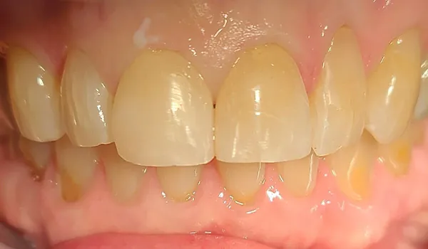 After image