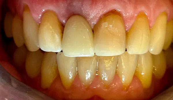 Dental Implants and Dental Bridges in Seattle | Missing Tooth Replacement 4 After image