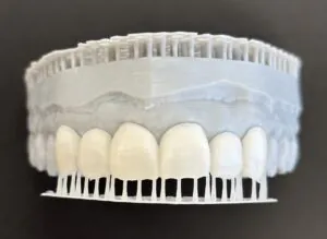 Porcelain Veneers in Seattle: No-Prep & Minimal Prep Options | Moritis & Shin Dentistry 3 IMG 2689 scaled e1785644101462