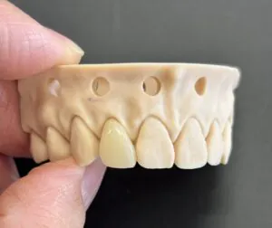 Porcelain Veneers in Seattle: No-Prep & Minimal Prep Options | Moritis & Shin Dentistry 2 IMG 2719 scaled e1785644216824