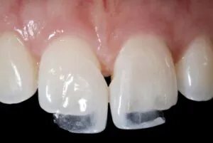 Porcelain Veneers in Seattle: No-Prep & Minimal Prep Options | Moritis & Shin Dentistry 1 IMG 2779