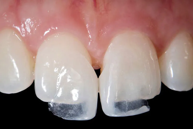 Cosmetic Dentistry 2 photo of dental bonding