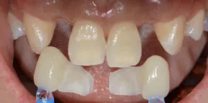 Tooth Replacement Options in Seattle: Implants, Bridges & More | Moritis & Shin Dentistry 1 maryland bridge