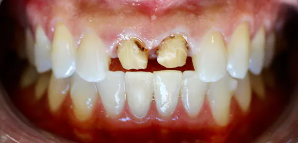 Dental Crown Seattle: Do You Need One, What It Costs & What to Expect | Moritis & Shin 1 Before image