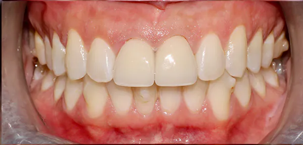 Dental Crown Seattle: Do You Need One, What It Costs & What to Expect | Moritis & Shin 2 After image