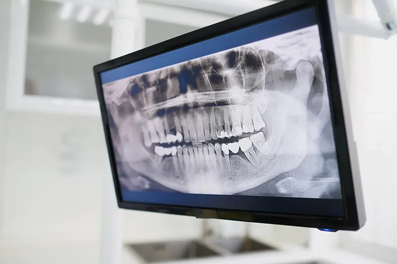 Why Are Dental X-Rays Necessary? | Moritis & Shin Dentistry 1 why are dental x rays necessary